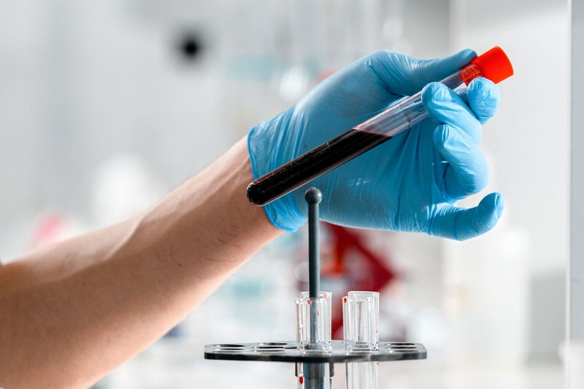 Testosterone Levels in Men Over 35: What the Numbers Actually Mean and What to Do About Them